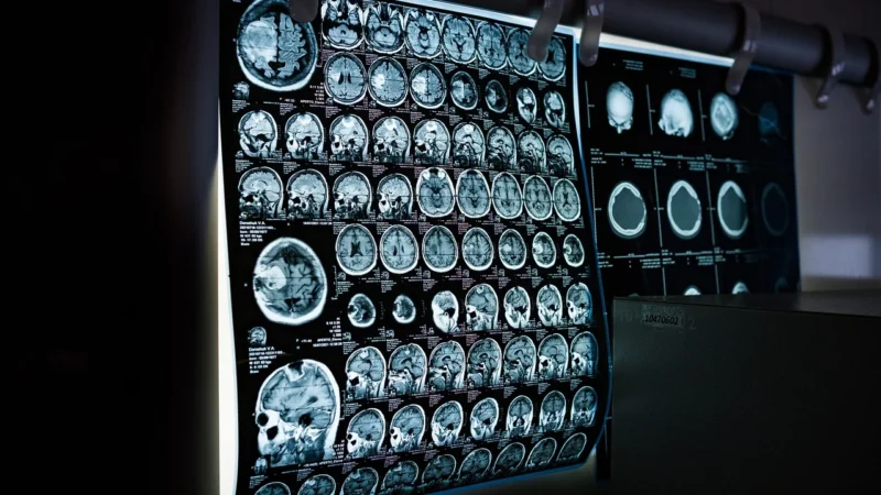 Objawy i diagnoza stwardnienia rozsianego